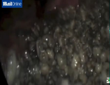 بالفيديو .. العثور على 100 يرقة داخل أنف رجل برازيلي بالفيديو .. العثور على 100 يرقة داخل أنف رجل برازيلي