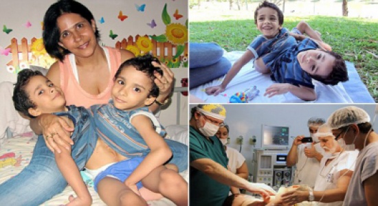 البرازيل: فصل توأمين ملتصقين برأسين وثلاثة أرجل