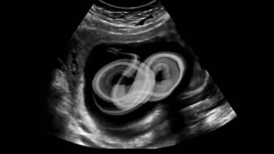 بالصور: فتاة تعاني من ألم غريب في معدتها فكانت المفاجأة مرعبة!