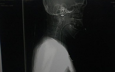 سهم يخترق رأسه ويظل على قيد الحياة