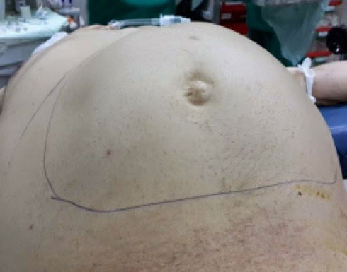 بالصور: استئصال أكبر ورم في العالم من بطن مريض في مستشفى بالقدس