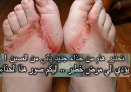 صورة| تحذير من حذاء خطير يأتي من الصين ويسبب مرض خطير! صورة| تحذير من حذاء خطير يأتي من الصين ويسبب مرض خطير!