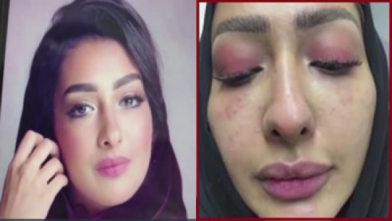 شاهد: خبيرة تجميل سعودية تشرح تجربة مدمرة مع الفيلر شاهد: خبيرة تجميل سعودية تشرح تجربة مدمرة مع الفيلر