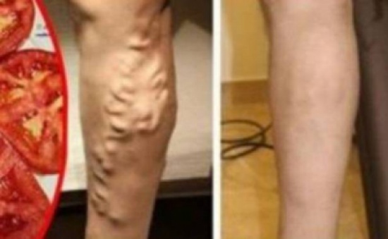 سيدة تقضي على الدوالي نهائياً من خلال هذه الطريقة البسيطة والزهيدة سيدة تقضي على الدوالي نهائياً من خلال هذه الطريقة البسيطة والزهيدة