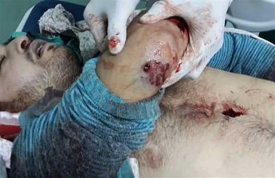 استشهاد فلسطيني برصاص قوة إسرائيلية داخل مستشفى في الخليل