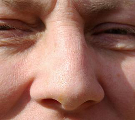 يقضم جزءاً من أنف خصمه في مشاجرة