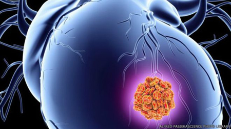 لصقة بروتنية قد تساعد في ترميم الضرر الناتج عن الإصابة بالنوبة القلبية