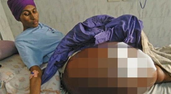 بالصور.. هندي يعيش 7 أعوام بـ "رجل" وزنها 55 كيلوغراماً بسبب ورم بالصور.. هندي يعيش 7 أعوام بـ "رجل" وزنها 55 كيلوغراماً بسبب ورم