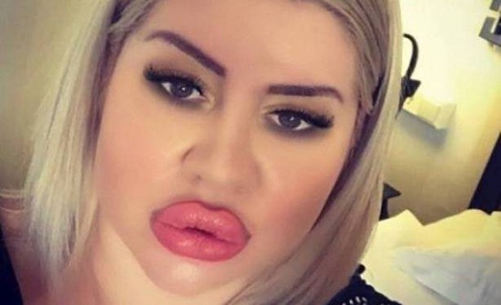 بالصور: بعد إدمانها عمليات التجميل.. شاهدوا كيف تحولت إلى بالون بشري!