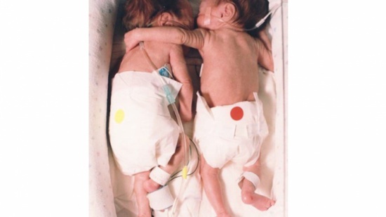 صورة توأم في الحاضنة هزّت الرأي العام... ماذا حصل بعد 20 عاماً؟