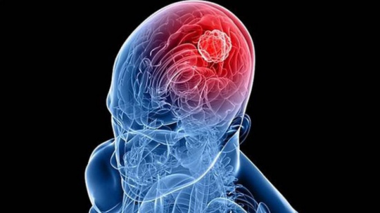 طريقة في متناول الجميع للوقاية من سرطان الدماغ