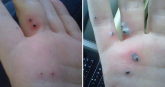 صور| لاحظت ظهور بقع سوداء على يدها .. وما اكتشفته كان مفاجئاً!!