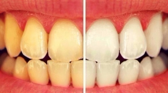 10 أطعمة ومشروبات تؤدي إلى اصفرار أسنانك 10 أطعمة ومشروبات تؤدي إلى اصفرار أسنانك