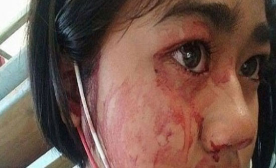 حالتها نادرة جداً والأطباء يحتارون في تشخيصها.. امرأة تتعرَّق "دماً" وتعيش حالة اكتئاب بسبب مرضها الغريب