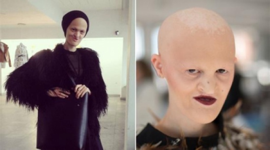 بريطانية صلعاء بلا أسنان تتحول لعارضة أزياء ناجحة