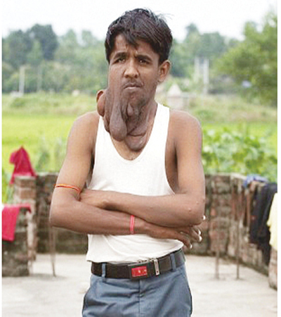 جراحة تعيد الأمل للرجل الفيل !! جراحة تعيد الأمل للرجل الفيل !!