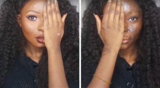 صور: أصبحت فنانة ماكياج بعد سخرية الجميع من حروقها