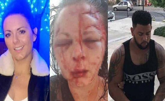 "اعتداء وحشي" يبدل ملامح شابة بريطانية في تركيا "اعتداء وحشي" يبدل ملامح شابة بريطانية في تركيا