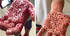 بالفيديو.. يد مليئة بالثقوب وتقطر دما تثير ذعر مستخدمي الإنترنت