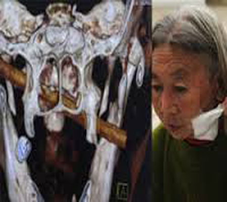 امرأة صينية تعيش وفي رأسها عصا دون علمها