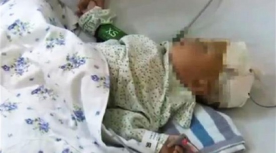 عود طعام يستقر في دماغ رضيع عشرة أيام