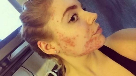 بالصورة: حمية غذائية تحوّل فتاة "الوجه المريض" إلى حسناء! بالصورة: حمية غذائية تحوّل فتاة "الوجه المريض" إلى حسناء!