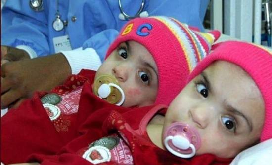 هل تذكرون التوأم الخليجي الملتصق صفاء ومروة.. هكذا أصبحتا بعد 11 عاماً