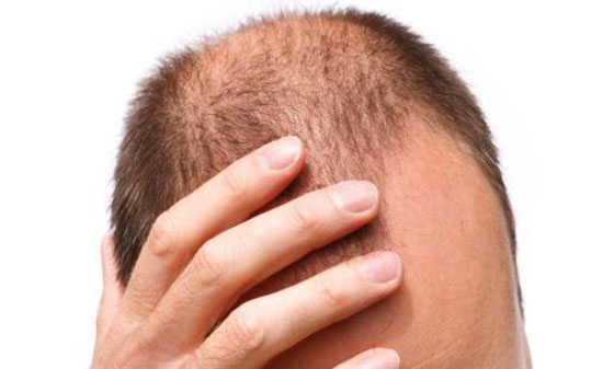 للرجال فقط.. 12 سبباً مدهشاً للصلع للرجال فقط.. 12 سبباً مدهشاً للصلع