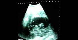 بالفيديو.. لقطات ترصد جنينًا يلعب «جمبازا» في رحم أمه