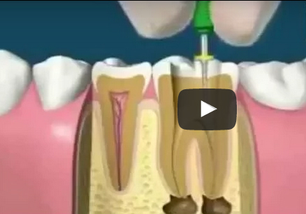 شاهد ما يفعله طبيب الأسنان في فم المريض