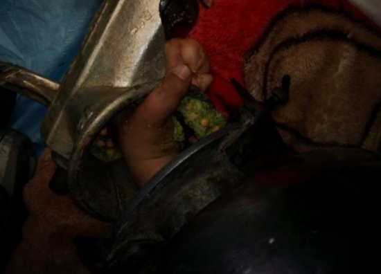 حادثة مؤلمة..بتر يد طفل انزلقت بـ"ماكنة فلافل"..صور