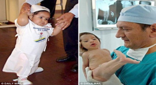 "متلازمة حورية البحر" بين الحقيقة والخيال