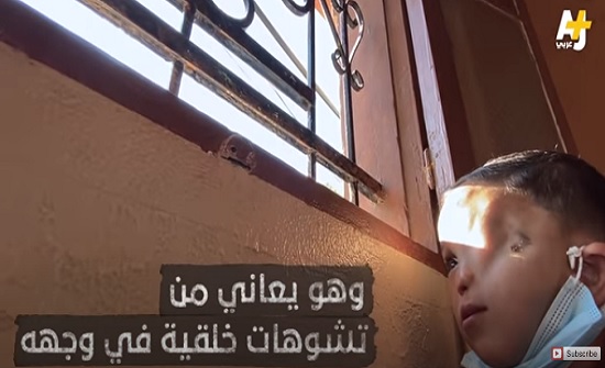 فيديو : طفل عربي بنصف وجه