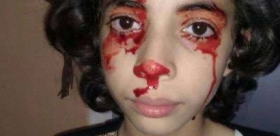 فيديو لمرض نادر وغريب في المغرب.. طفلة تنزف دما من كل جسدها فيديو لمرض نادر وغريب في المغرب.. طفلة تنزف دما من كل جسدها