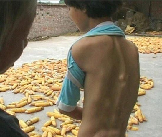 «صينيَّة» تتحول إلى «حجر» بسبب تصلب أنسجتها الرخوة!