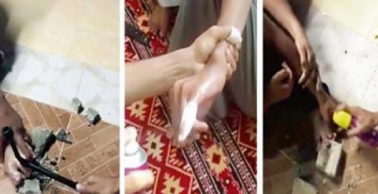 كسروا اصابع صديقهم من أجل اجازة