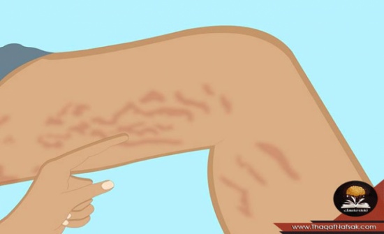 8 طرق تخلصك من علامات التمدد والخطوط البيضاء فى الجسم.... 8 طرق تخلصك من علامات التمدد والخطوط البيضاء فى الجسم....