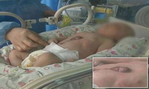 بالفيديو: لحظة مؤثرة لطفل ولد بقلب خارج بطنه بالفيديو: لحظة مؤثرة لطفل ولد بقلب خارج بطنه