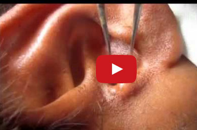 مئات اليرقات تتكاثر داخل أذن رجل