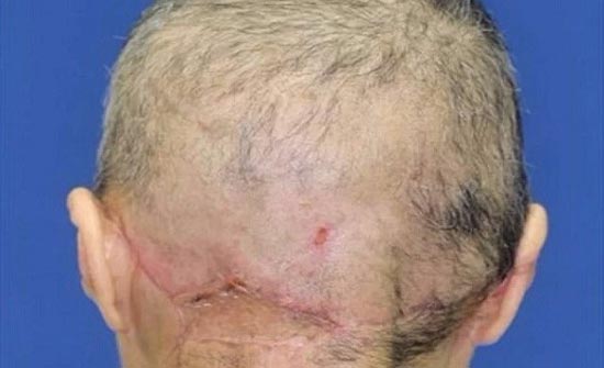 سيدة فقدت فروة رأسها بالكامل بآلة غزل القطن! سيدة فقدت فروة رأسها بالكامل بآلة غزل القطن!