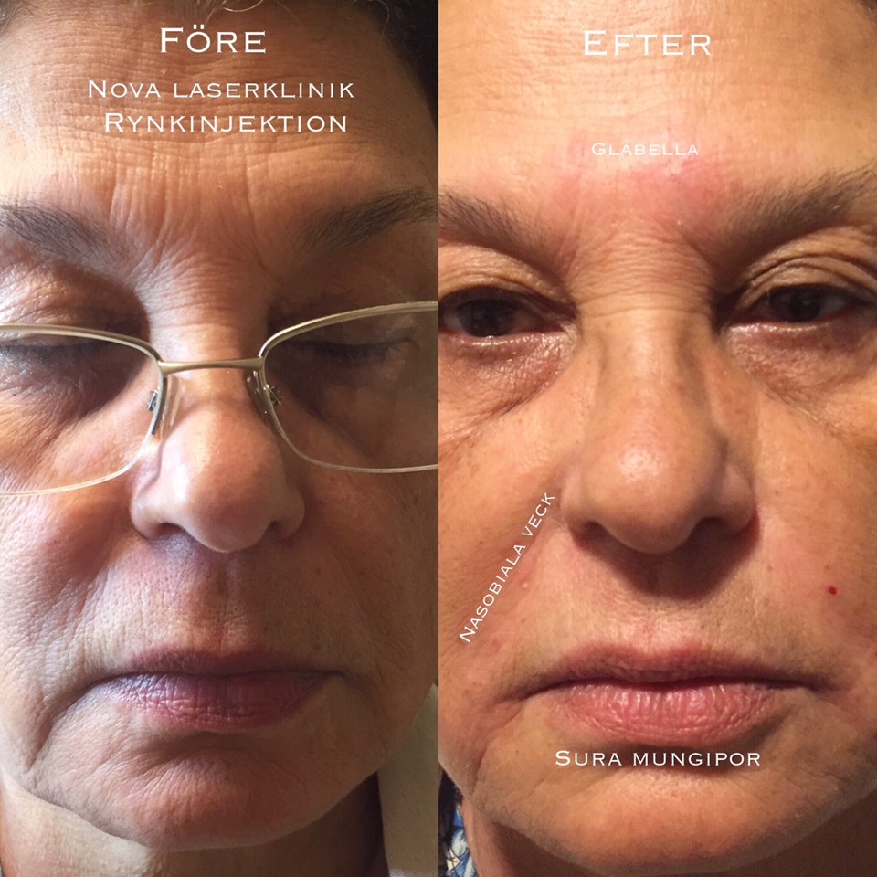 laserkliniken göteborg omdöme laserkliniken göteborg omdöme