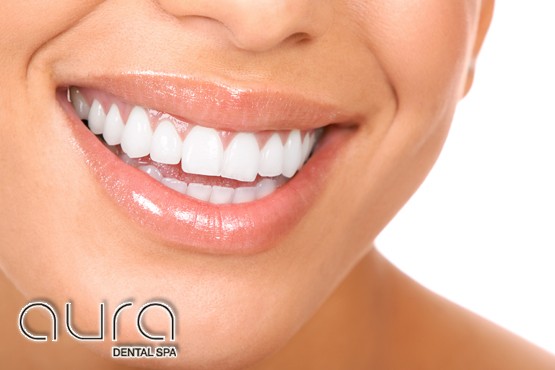 £449 for 2 porcelain veneers, £799 for 4 porcelain veneers or £1499 for 8 porcelain veneers, inc. consultation at Aura Dental Spa - save up to 63%