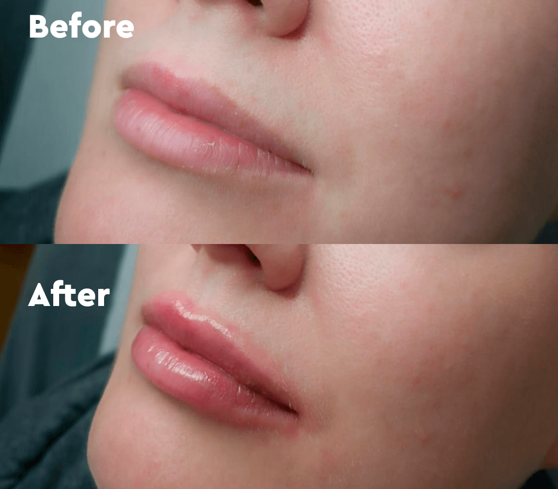 Benefits of Dermal Fillers