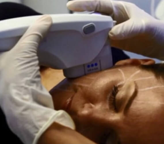 Procedure of Ultherapy