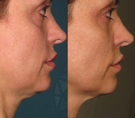 Benefits of Ultherapy