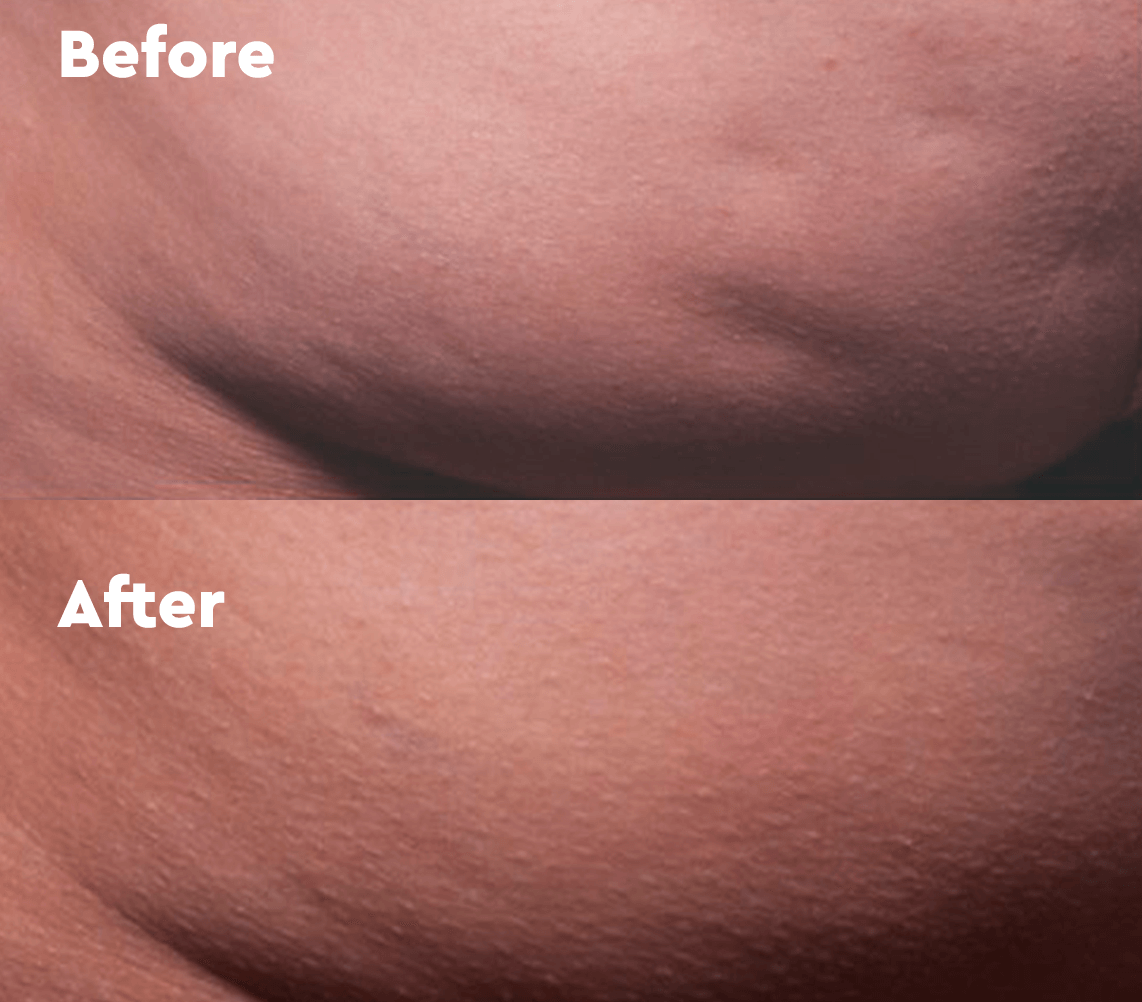 Benefits of Cellfina Cellulite Removal