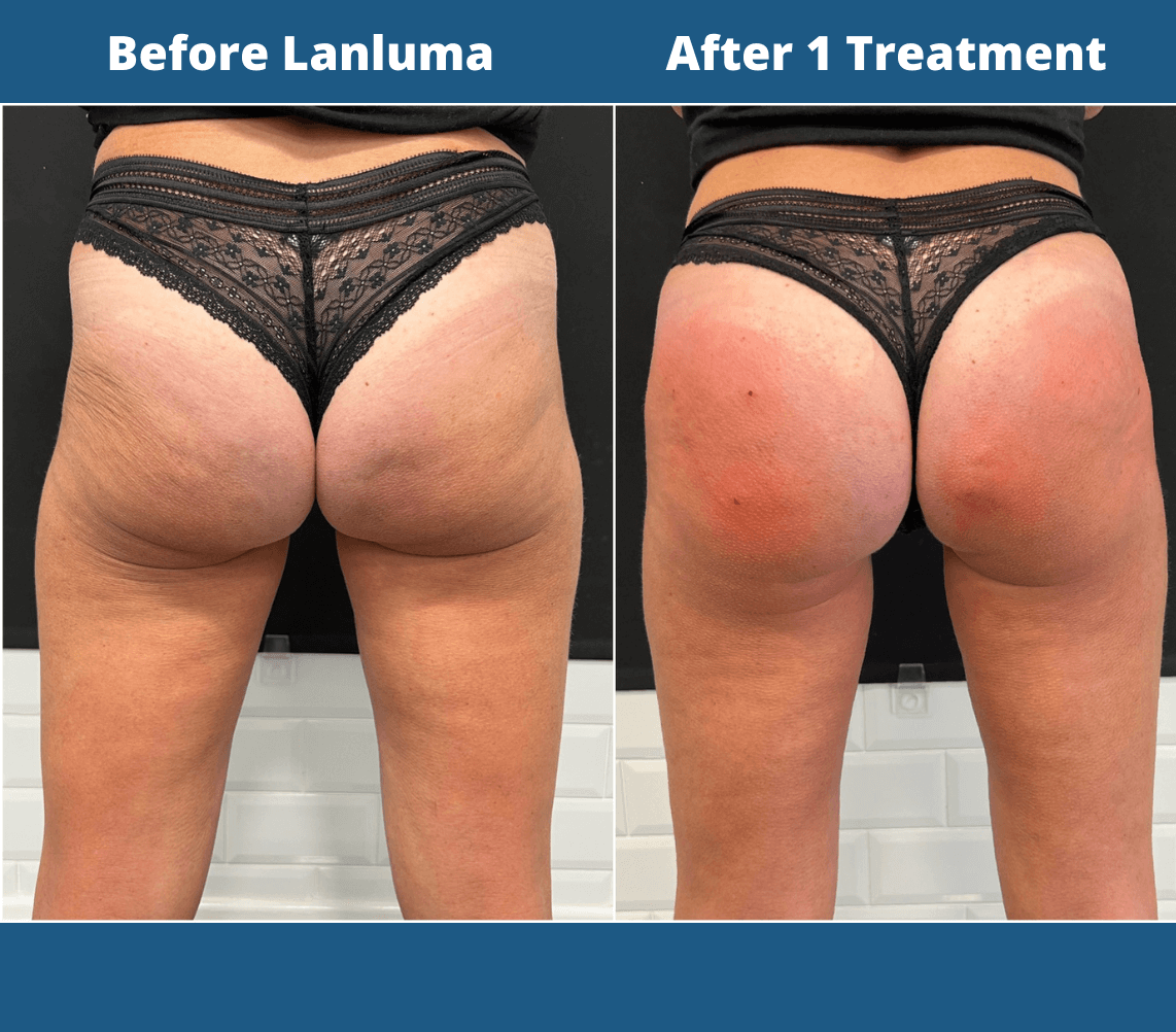 Benefits of Lanluma Bum Lift