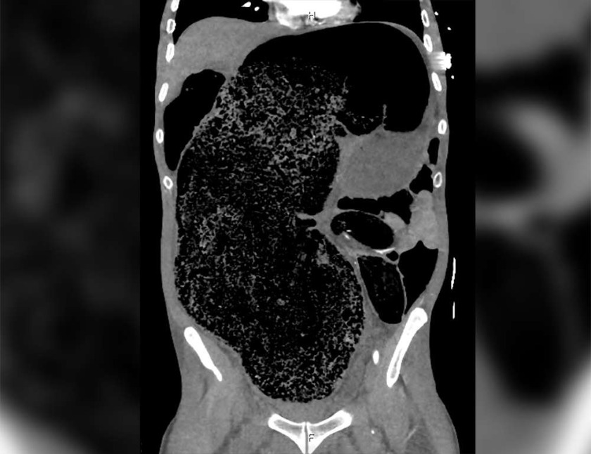 A scan of the constipated man's abdomen.