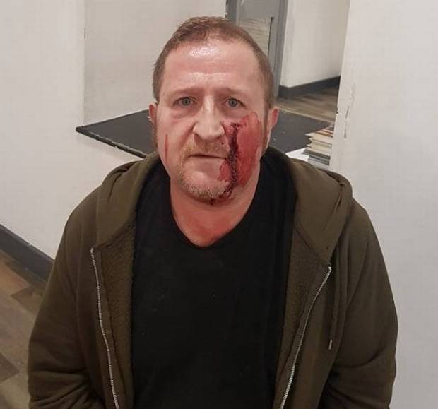 "They Were Trying To Kill Me" - Man Speaks Out About Homophobic Attack In Coolock