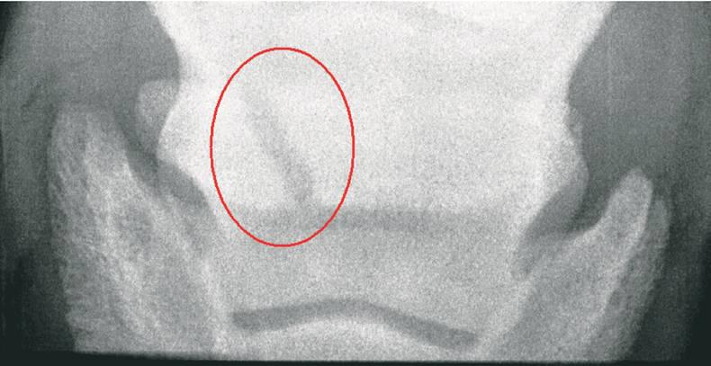 HANDS ON: Pedal bone and navicular bone fractures